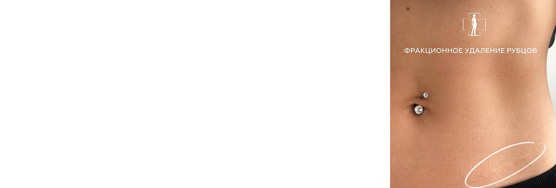 Как мы удаляем рубцы